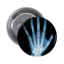 Blaue Röntgenstrahl-Skelett-Hand Anstecknadelbuttons