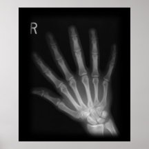 Extrastellen-Röntgenstrahl-rechte Hand Posterdrucke