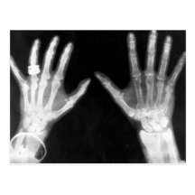 Röntgenstrahl-Skeleton Hände u. Schmuck - B&W Postkarten