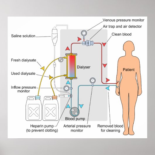 Abbildung einer Hämodialyse Medizinische Behandlun Poster (Vorne)
