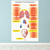 Abbildung eines amniotischen Flüssigkeitsembolismu Leinwanddruck (Insitu (Holzboden))