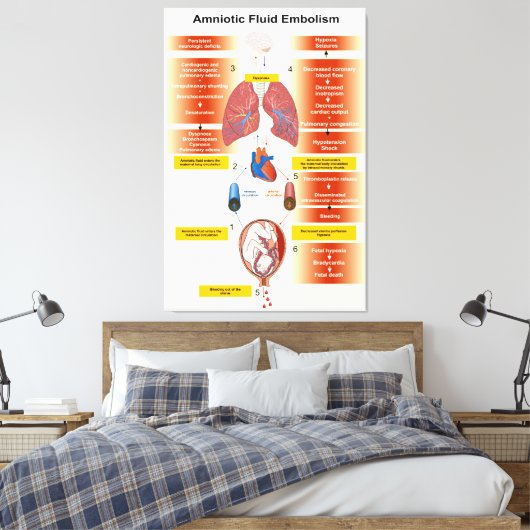 Abbildung eines amniotischen Flüssigkeitsembolismu Leinwanddruck (Insitu (Schlafzimmer))