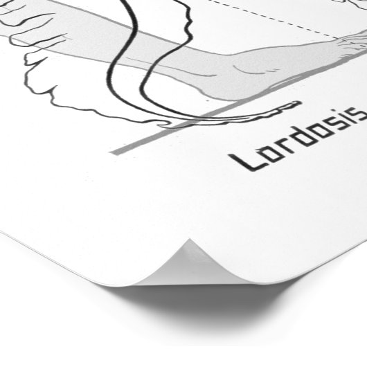 Abnormal Curves of the Spine Poster Chiropractic (Ecke)