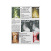 Abreißen von Pad Subluxation Zervikalische Entkern Notizblock (Rotiert)