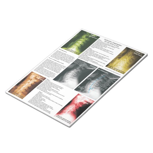 Abreißen von Pad Subluxation Zervikalische Entkern Notizblock (angewinkelt)