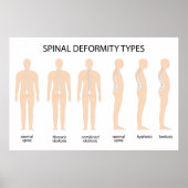 Anatomie der Wirbelsäulenfehlbildung Poster (Vorne)