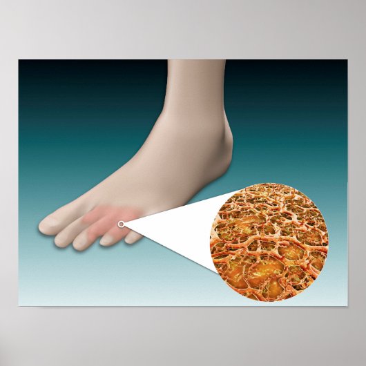 Anatomie des Foot Fungus mit mikroskopischer Nah-u Poster (Vorne)