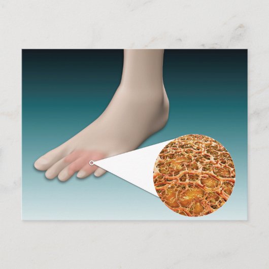 Anatomie des Foot Fungus mit mikroskopischer Nah-u Postkarte (Vorderseite)