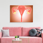 Anatomie des weiblichen Uterus mit Ovarien Leinwanddruck (Insitu (Wohnzimmer))