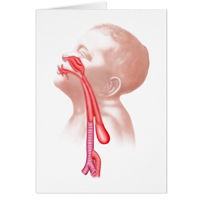 Anatomie einer Tracheesophagealfistula (Vorne)