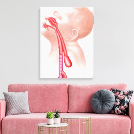 Anatomie einer Tracheesophagealfistula Leinwanddruck (Insitu (Wohnzimmer))