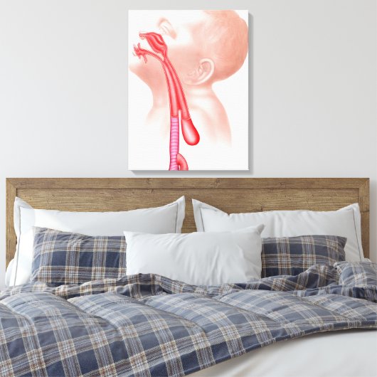 Anatomie einer Tracheesophagealfistula Leinwanddruck (Insitu (Schlafzimmer))