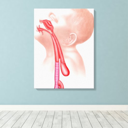 Anatomie einer Tracheesophagealfistula Leinwanddruck (Insitu (Holzboden))