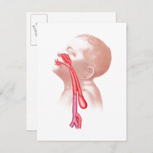 Anatomie einer Tracheesophagealfistula Postkarte (Vorne/Hinten)