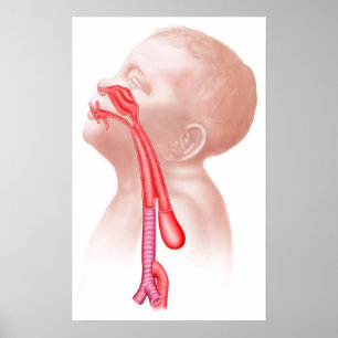 Anatomie einer Tracheoesophageal Fistel Poster