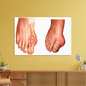 Anatomie eines geschwollenen Fußes Leinwanddruck (Insitu (Wohnzimmer))