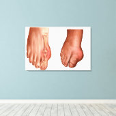 Anatomie eines geschwollenen Fußes Leinwanddruck (Insitu (Holzboden))