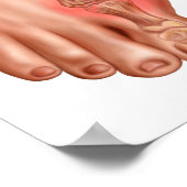 Anatomie eines geschwollenen Fußes Poster (Ecke)