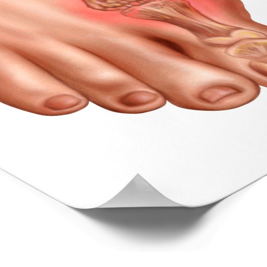 Anatomie eines geschwollenen Fußes Poster (Ecke)