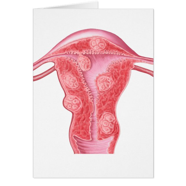 Anatomie fibroider Tumoren bei weiblichen Uterusze (Vorne)