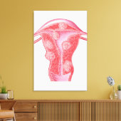 Anatomie fibroider Tumoren bei weiblichen Uterusze Leinwanddruck (Insitu (Wohnzimmer))