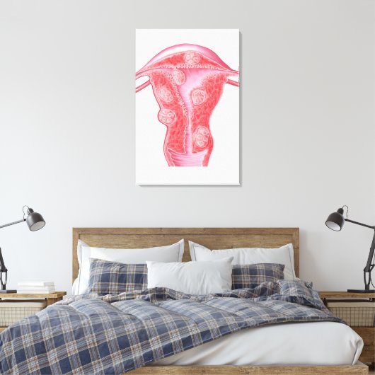 Anatomie fibroider Tumoren bei weiblichen Uterusze Leinwanddruck (Insitu (Schlafzimmer))