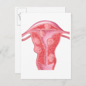 Anatomie fibroider Tumoren bei weiblichen Uterusze Postkarte (Vorne/Hinten)