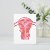 Anatomie fibroider Tumoren bei weiblichen Uterusze Postkarte (Stehend Vorderseite)
