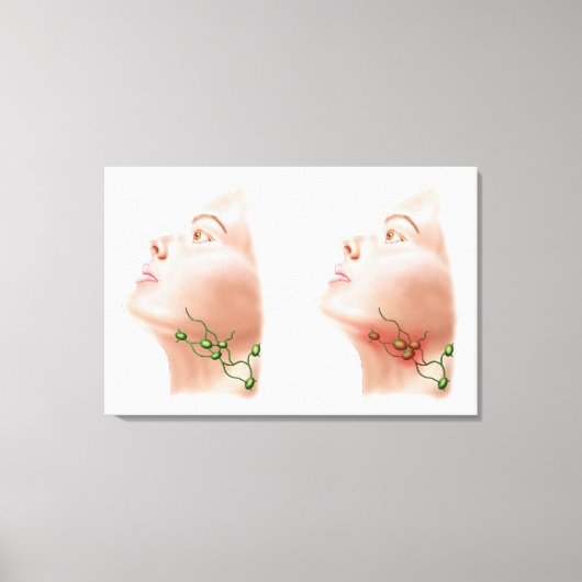 Anatomie geschwollener Lymphknoten Leinwanddruck (Vorderseite)