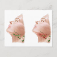 Anatomie geschwollener Lymphknoten