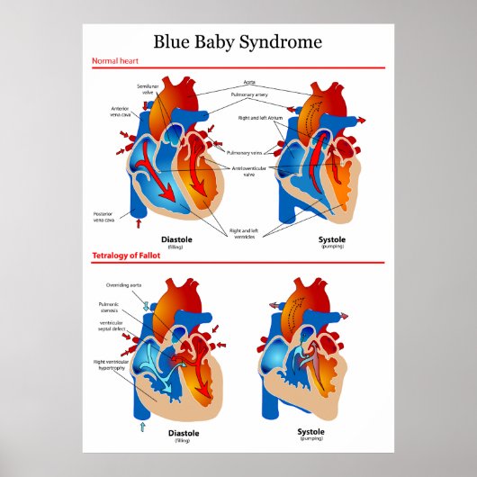 Anatomisches Herzdiagramm des Blue-Baby-Syndroms Poster (Vorne)