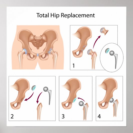 Angesagter Ersatzdruck für Operationen insgesamt Poster (Vorne)
