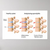 Ankylosierende Spondylitis Poster (Vorne)