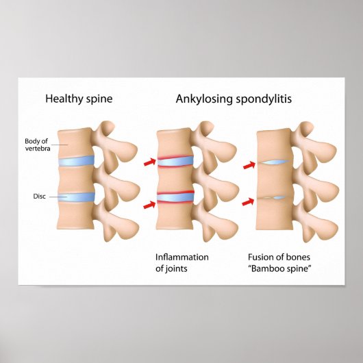 Ankylosierende Spondylitis Poster (Vorne)