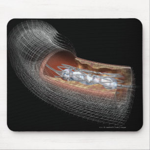 Ansicht eines angioplaty Ballons in einer Arterie Mousepad