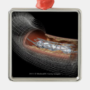 Ansicht eines angioplaty Ballons in einer Arterie Ornament Aus Metall