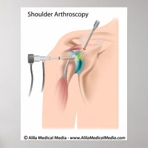Arthroskopie-Diagramm. Poster