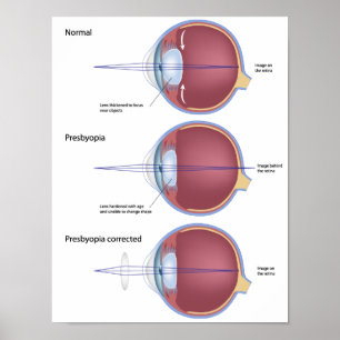 Augendefekt Presbyopia Poster