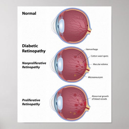 Augenerkrankung Diabetische Retinopathie Poster (Vorne)