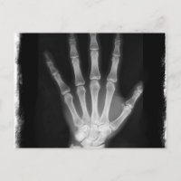 B&W Röntgen Skeleton Hand