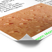 Babesia Symptome und Transmission Poster (Ecke)