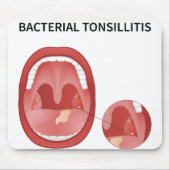 Bakterielle Tonsillitis Mousepad (Vorne)