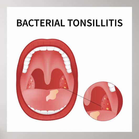 Bakterielle Tonsillitis Poster (Vorne)