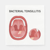 Bakterielle Tonsillitis Serviette (Vorderseite)