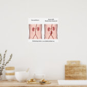 Bauchschmerzendes Aneurysma-Poster Poster (Küche)