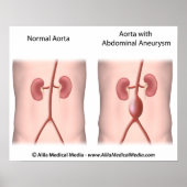 Bauchschmerzendes Aneurysma-Poster Poster (Vorne)