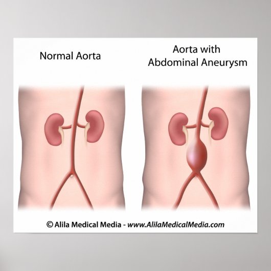Bauchschmerzendes Aneurysma-Poster Poster (Vorne)