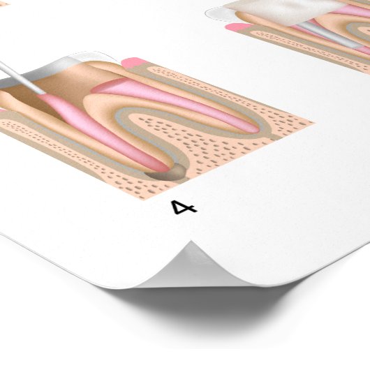 Behandlung des Root Canal Jede Größe Poster (Ecke)