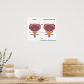 Benigne Prostatahyperplasie, beschriftet. Poster (Küche)
