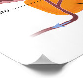 Benignes Prostatahyperplasie Poster (Ecke)